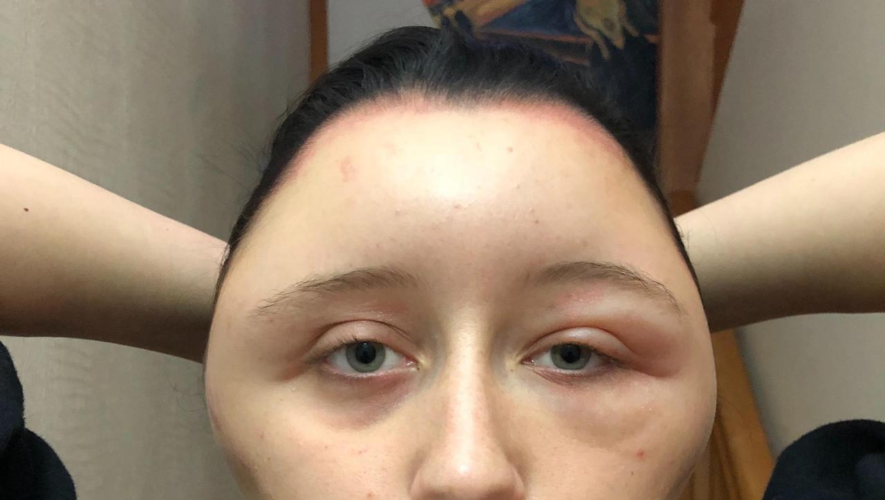 woman-suffers-allergic-reaction-from-hair-dye.jpg