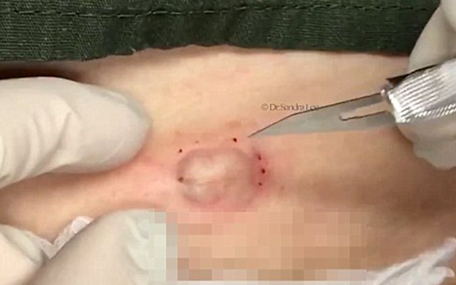 The Worst Blackhead Video Ever!