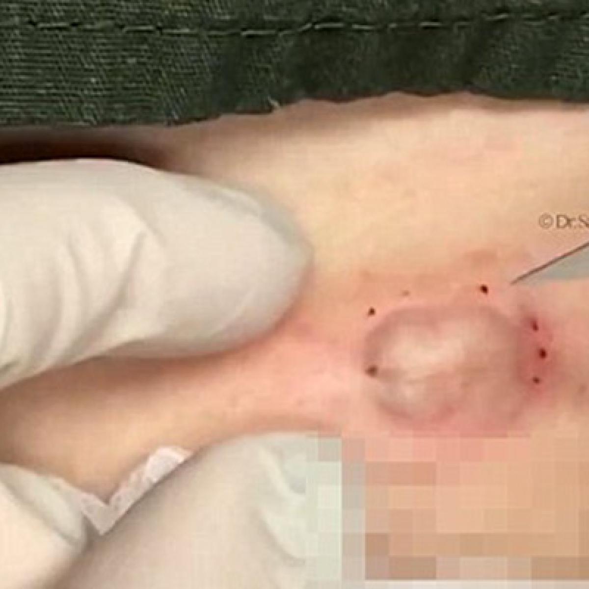 The Worst Blackhead Video Ever
