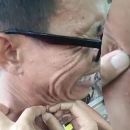 Man Squeezes 20 Year Old Blackhead From His Neck, We Spew