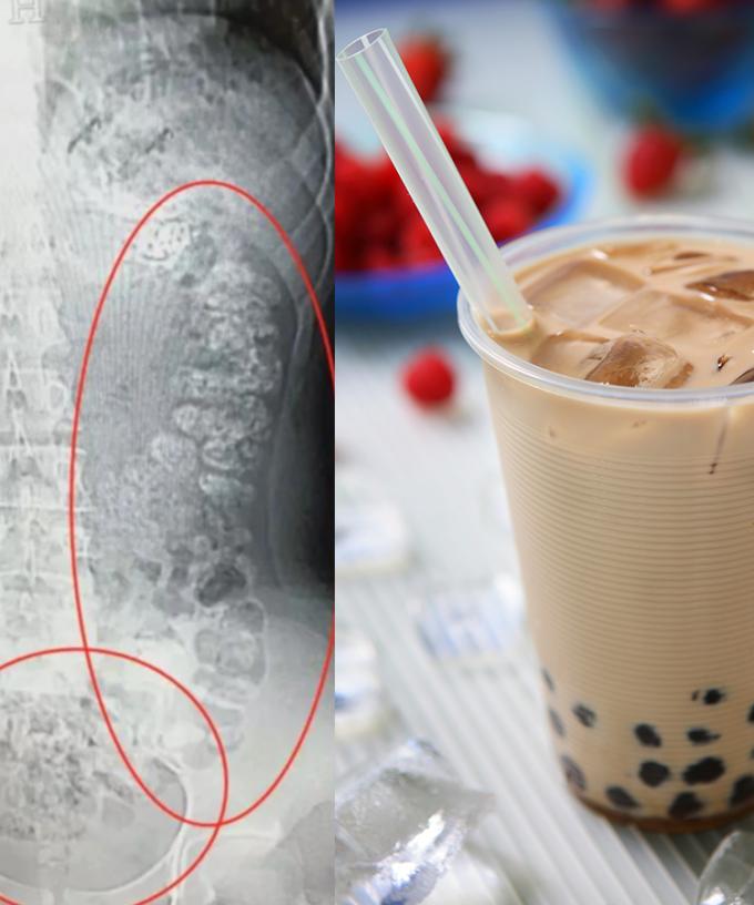 Teen Goes Into Coma After Drinking Too Much Bubble Tea How bubble tea became an american obsession. after drinking too much bubble tea